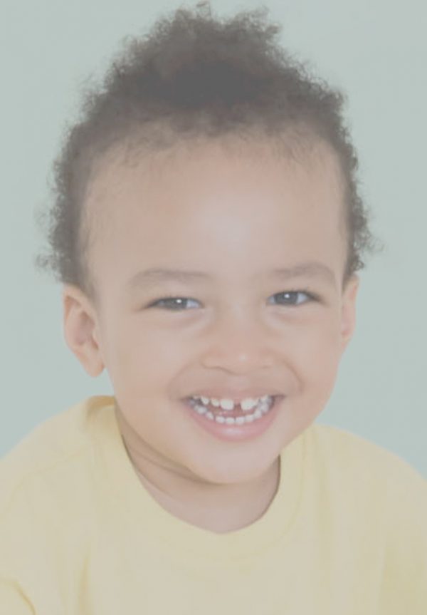 A Complete Guide To Dental Bonding And Its Benefits