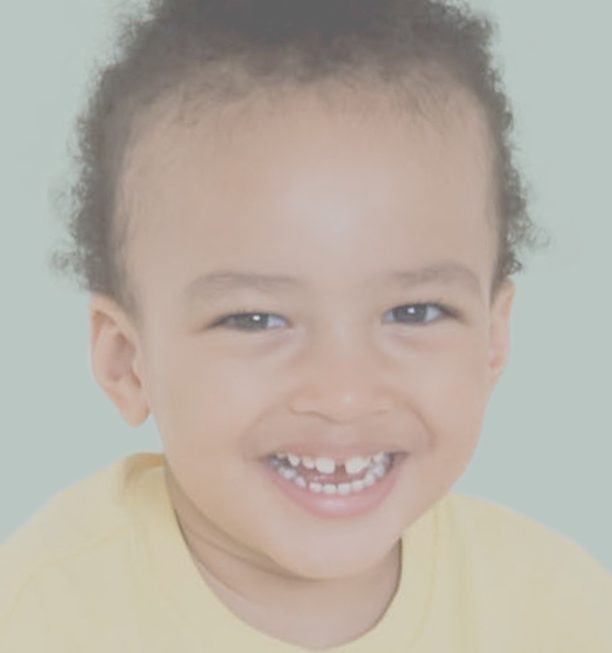 A Complete Guide To Dental Bonding And Its Benefits